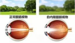 警惕！被白内障遮挡的眼病