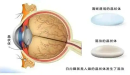 白内障手术后眼前有黑影飘动是怎么回事？