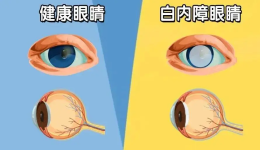 白内障手术后，应该注意什么？