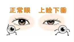 老年朋友眼睛睁不开？可能是上睑下垂惹的祸