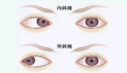 斜视危害知多少