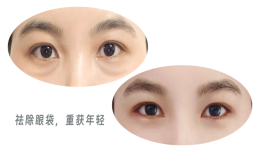 主打年轻的“眼袋祛除术”——美容整形专家涂晓宇为你介绍