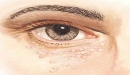 眼睑腺管瘤影响美观，如何解决？