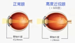高度近视患者 要警惕这4种致盲性眼底病
