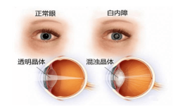让视力更清晰舒适的屈光性白内障手术