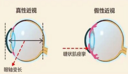 真性近视和假性近视的区别