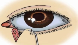 眼外伤一期缝合处理很重要，请选择正规医院