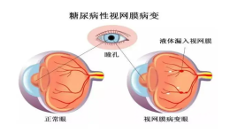 糖尿病视网膜病变如何预防