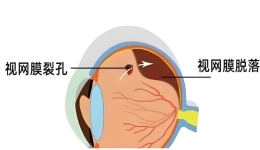 近视手术前发现眼底“洞”，莫慌！专家教你科学应对
