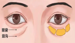 快速年轻化的微创祛眼袋手术