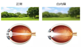 了解老年性白内障的诊治、预防