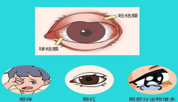 眼睛干痒难耐，警惕春季过敏性结膜炎