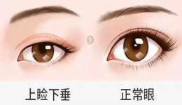 眼皮为什么会出现沉重感，如何解决？