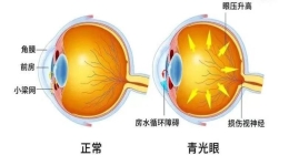 预防隐形“视力杀手”青光眼