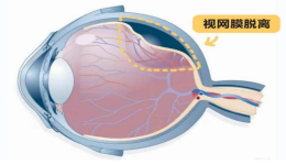 高度近视患者，不要参加剧烈运动