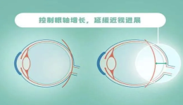 第一次验配角膜塑形镜？这份超详细的新手攻略快收好！