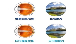 老年白内障的治疗和预防