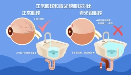 青光眼的这些常见误区千万别再信了！