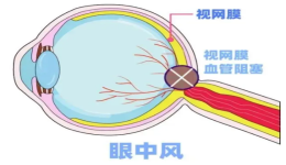 患有高血压 当心“眼中风”