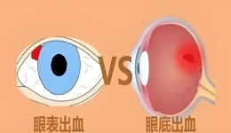 “眼表出血”与“眼底出血”的区别，哪个更严重？