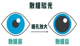 暑假配镜高峰来临，说说散瞳验光那些事