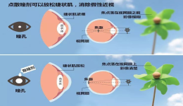 如何区分假性近视or真性近视