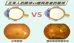 别让糖网“网”住你的眼睛