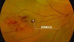 眼底一张照 疾病早知道