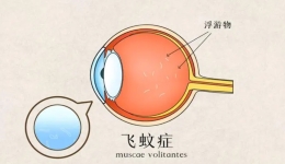 飞蚊症患者的福音——玻璃体激光消融术